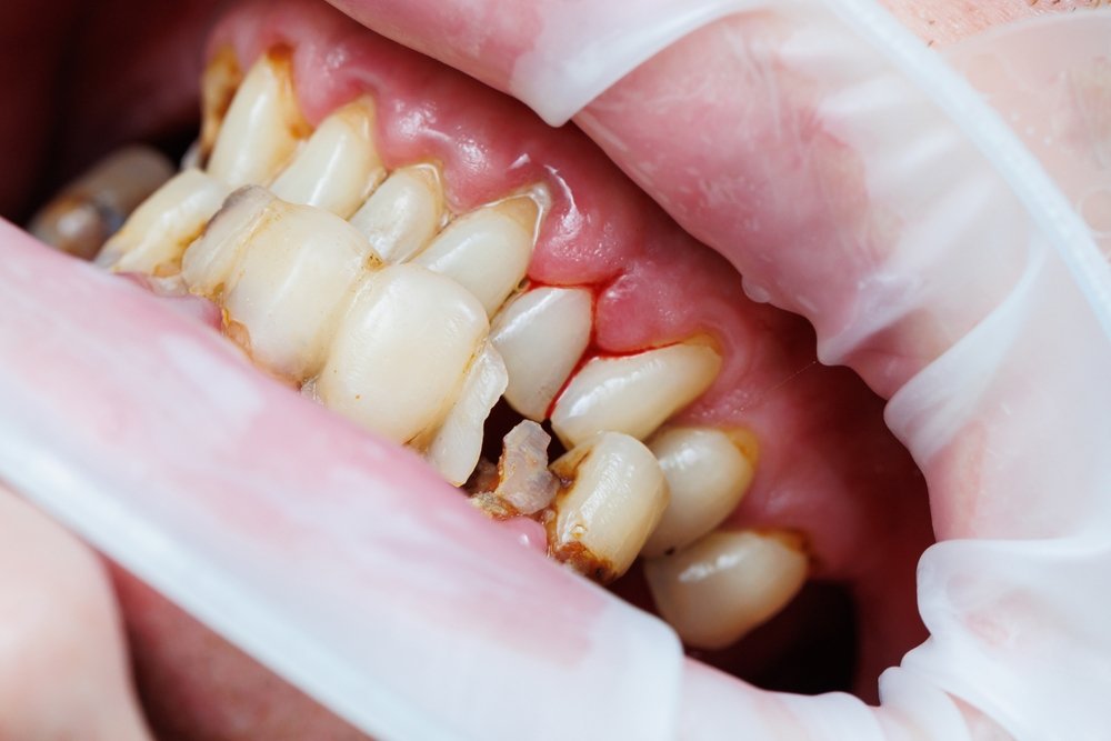 Cracked,Teeth.,Chipped,Tooth.chipped,Piece,Of,A,Dead,Pulp,Tooth.