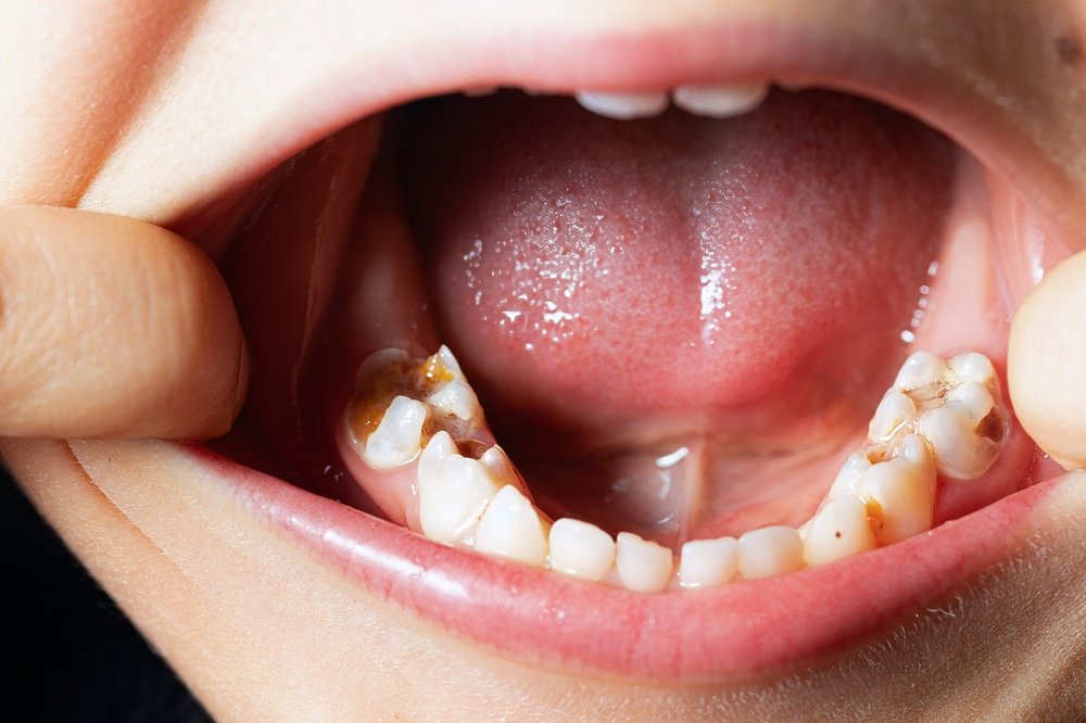 Detailed,Close-up,Inside,A,Mouth,,Focusing,On,Teeth.,Notable,Cavities